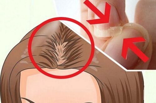 Hair and nail problems caused by parasites
