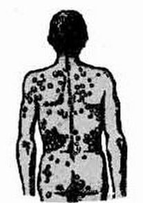 Probable infection options